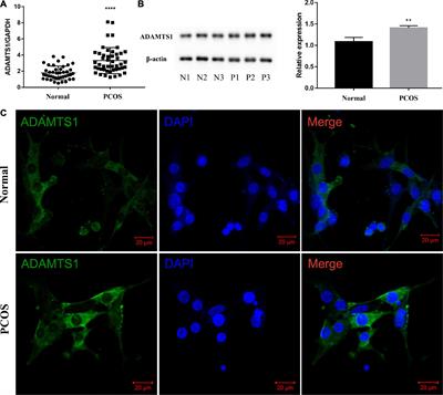 Expression Level of ADAMTS1 in Granulosa Cells of PCOS Patients Is Related to Granulosa Cell Function, Oocyte Quality, and Embryo Development